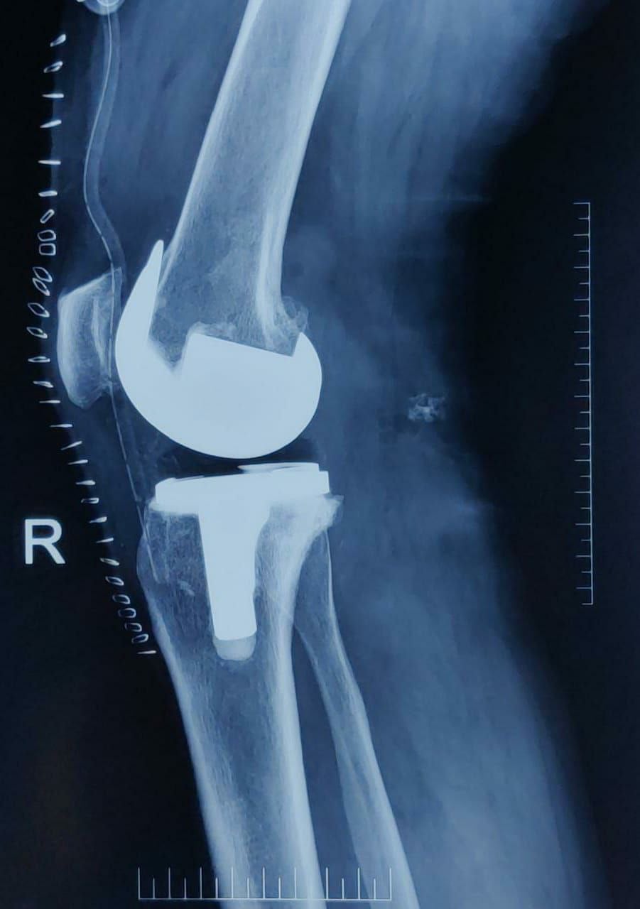 Post-Op: Bilateral Total Knee Replacement