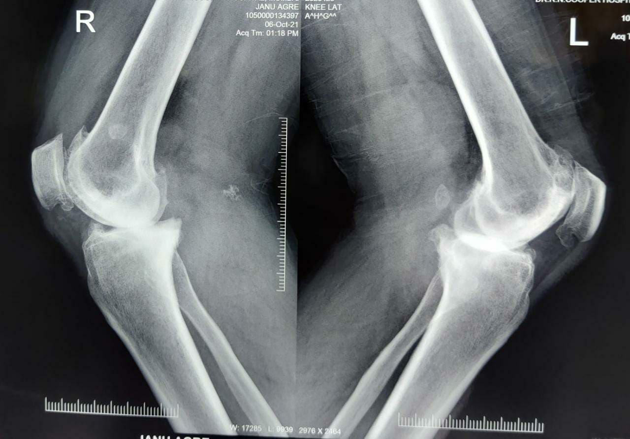 Pre-Op: Bilateral Total Knee Replacement