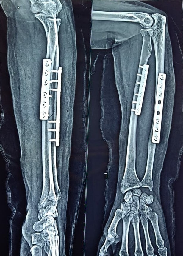 Post-Op: Direct Anterior Hip Replacement (DAA)