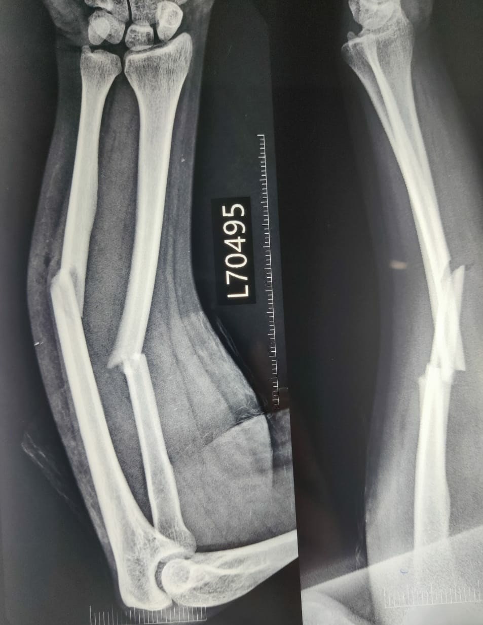 Pre-Op: Direct Anterior Hip Replacement (DAA)