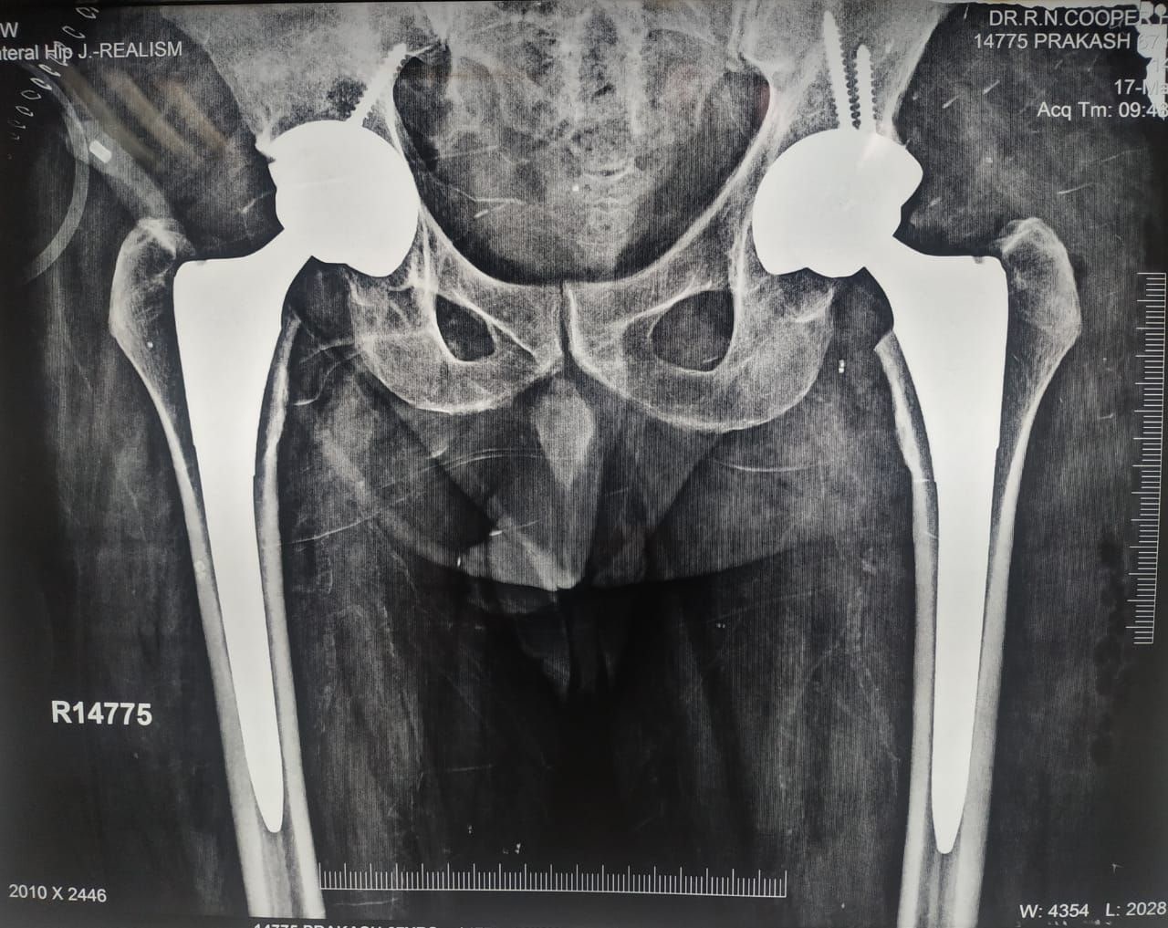 Post-Op: Complex Articular Fracture Biological Fixation
