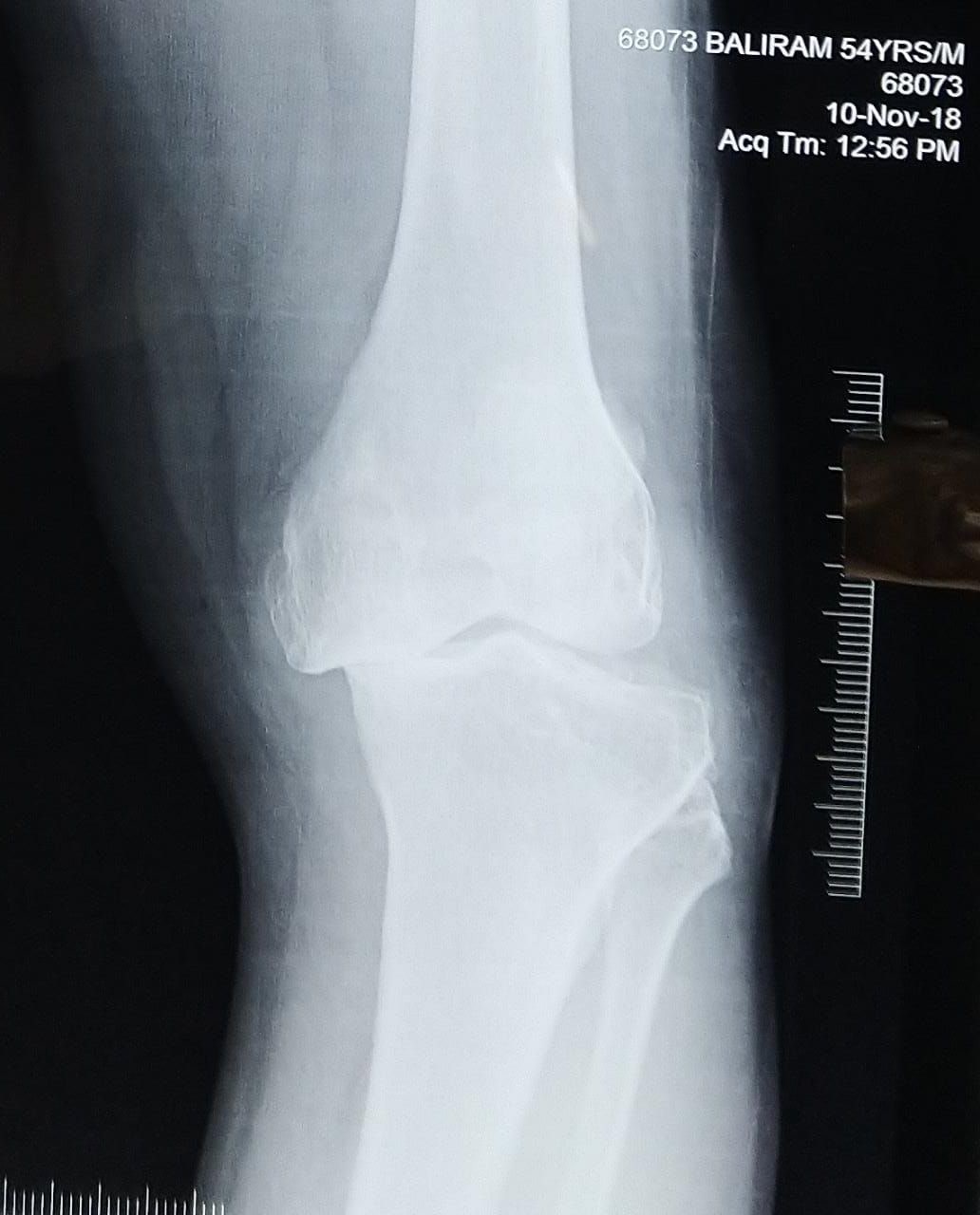 Pre-Op: Ankle Fracture & Ligament Realignment