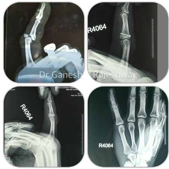 Pre-Op: Complex Articular Fracture Biological Fixation