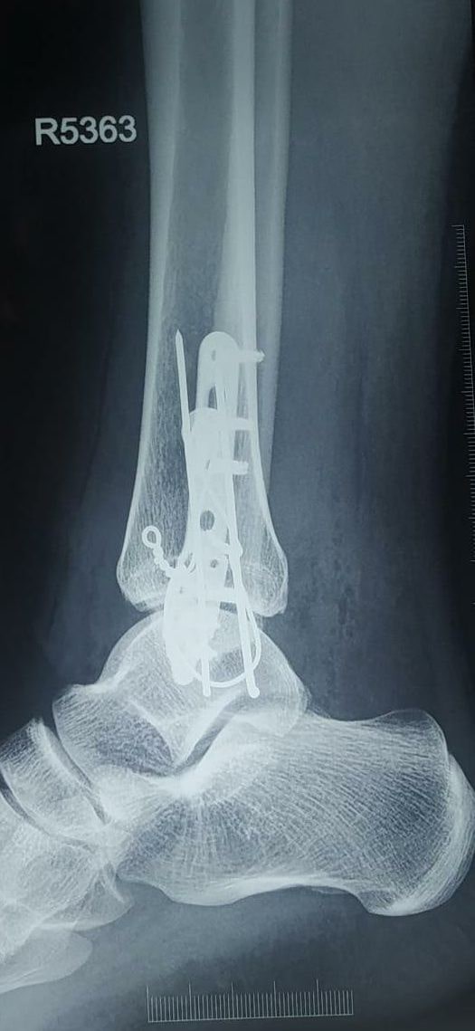 Post-Op: Ankle Fracture & Ligament Realignment