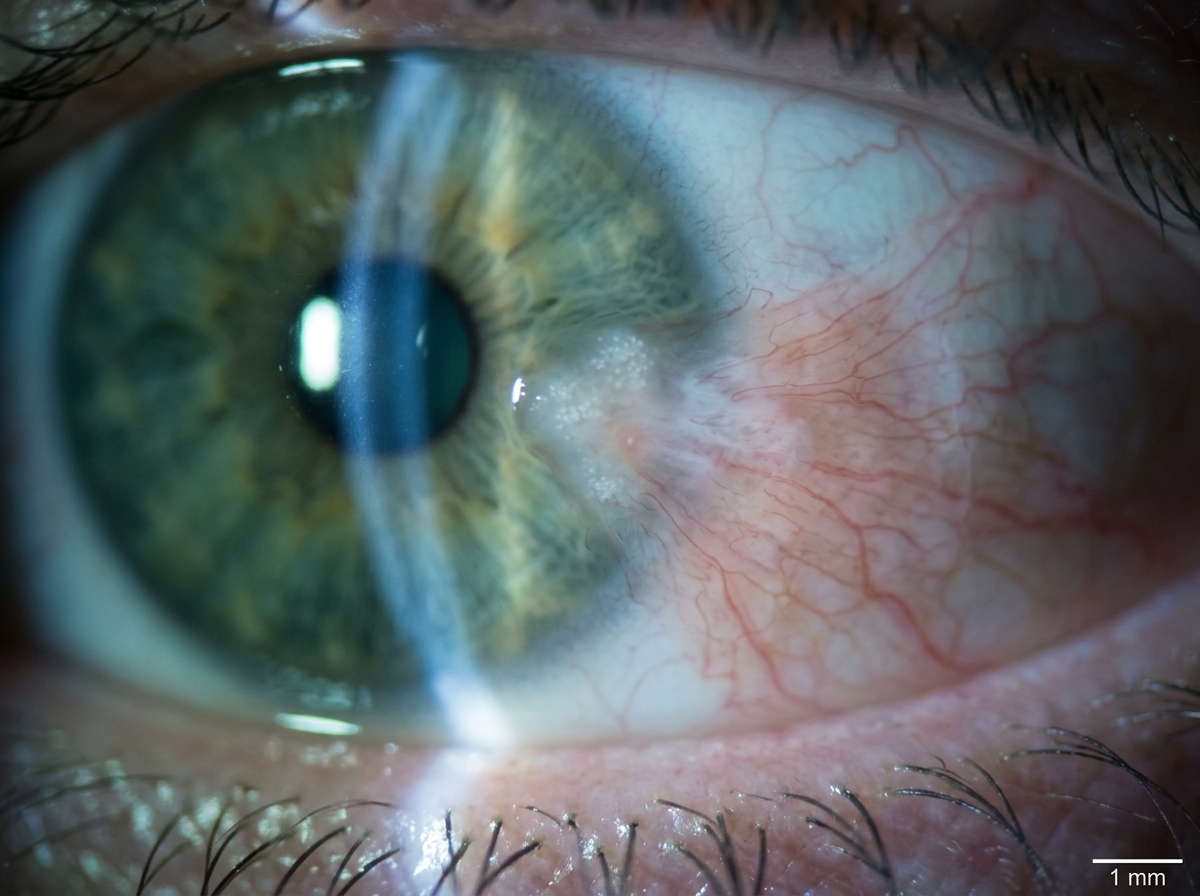Pre-Op: Pterygium Excision with Conjunctival Autograft