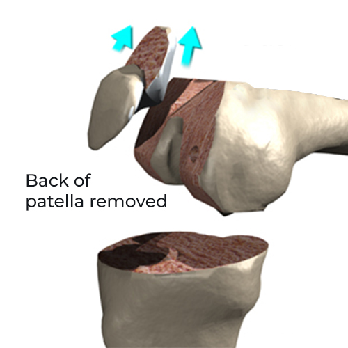 Back of patella removed