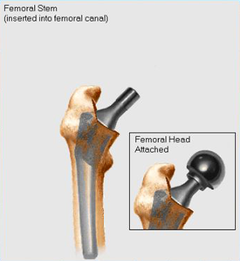 Femoral head impaction