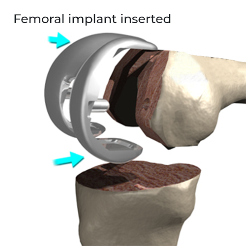 Femoral implant inserted