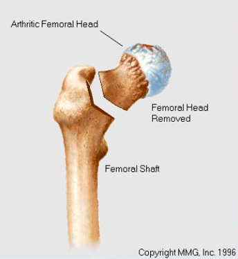 Femoral neck resection