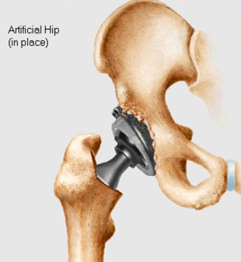 Artificial hip implant