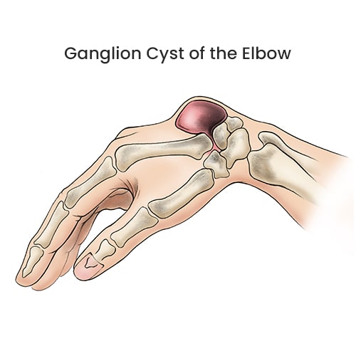 Ganglion Cyst of the Elbow