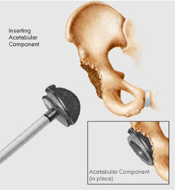 Insertion of acetabular component