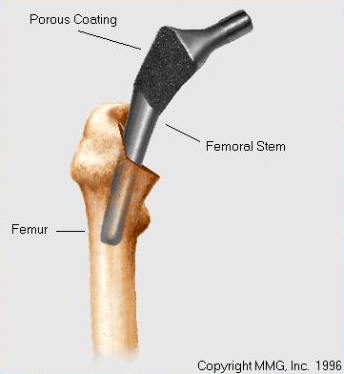 Insertion of femoral component