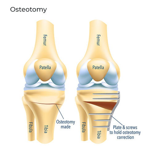 Osteotomy