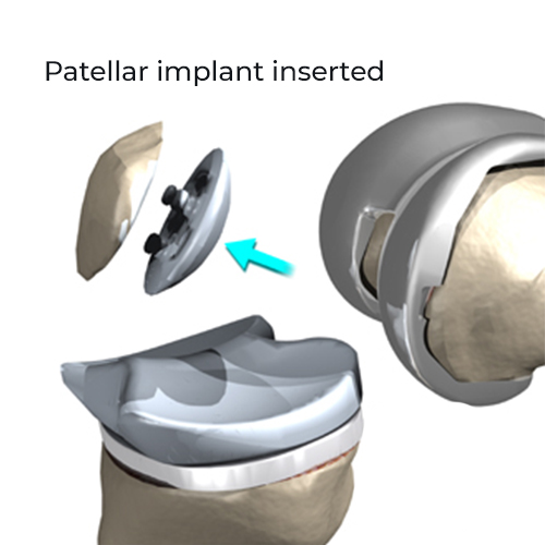 Patellar implant inserted