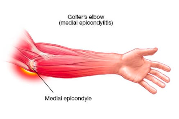 Golfer's Elbow