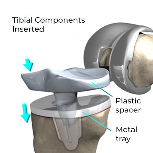 Tibial Components
