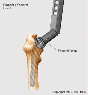 remaining broaching of femoral component