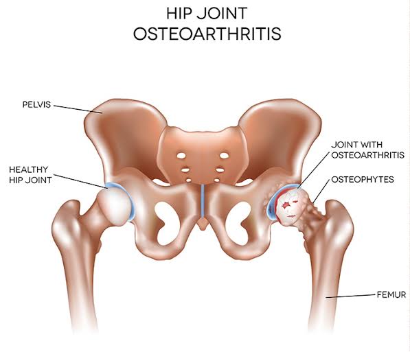 Hip Joint Osteoarthritis